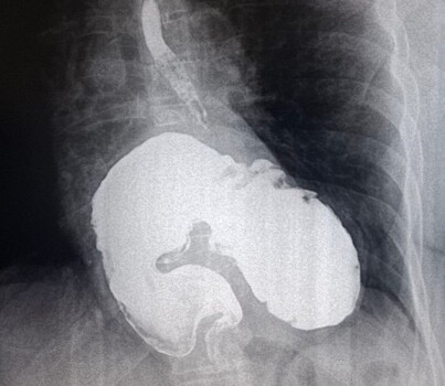 Врачи ККБ №2 случайно обнаружили гигантскую грыжу у жительницы Краснодара