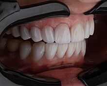 Врач заявила, что зубочистки могут принести больше вреда, чем пользы