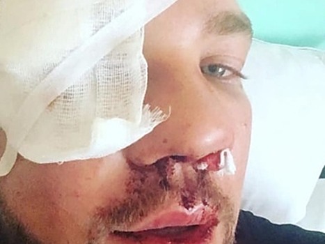 «Нос собрали по частям»: новые фотографии изувеченного дагестанцами Романа Ковалева