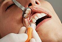 Стоматолог назвал причины прозрачности зубов