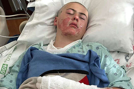 В США школьник получил ожоги по всему телу, повторяя эксперимент из TikTok