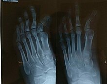 Подмосковные врачи воссоздали 12-летней девочке деформированные кости пальца на ноге