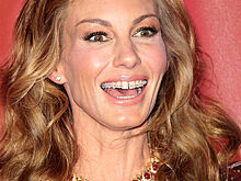 Брекеты или виниры: как сделать зубы ровными и красивыми