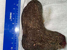 В Томской области хирурги извлекли ком волос из желудка ребенка