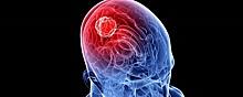 Ученые: Частые головные боли могут говорить о развитии опухоли мозга