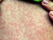 В Воронежской области непривитый ребёнок заболел корью