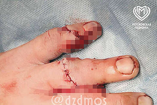 В Москве микрохирурги спасли мужчине отрезанные пальцы