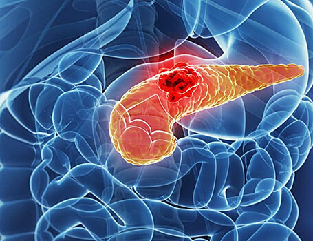 Cancer Cell: лекарство предотвращает утрату части ДНК, важной для борьбы с раком