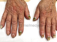 Синегнойную палочку обнаружили у нижегородки на ногтях после гель-лака