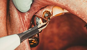Стоматолог рассказал, к чему могут привести запущенные проблемы с зубами
