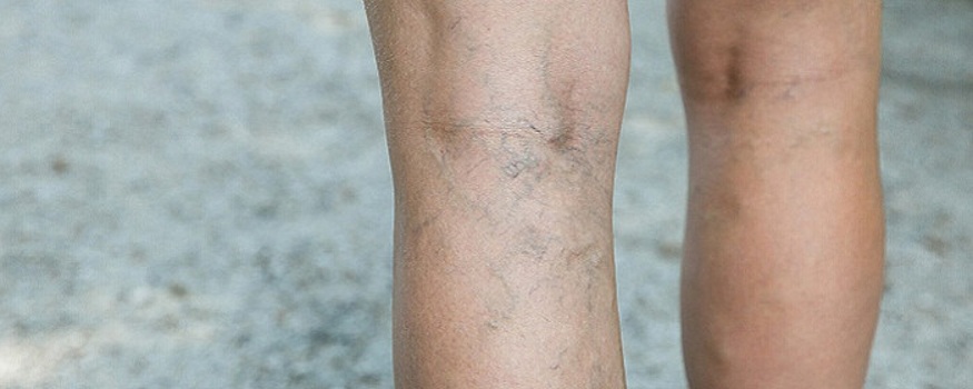 Флеболог Волков рассказал о методах лечения варикоза