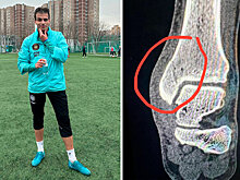 У Сэмио перелом медиальной лодыжки большеберцовой кости. Защитник пропустит 7-9 недель