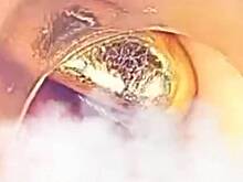 В желудке ребенка нашли золотой слиток стоимостью 865 тысяч рублей