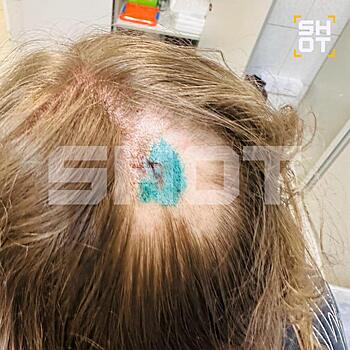 Чайка трижды атаковала россиянку — девушке пришлось сбрить волосы, чтобы обработать рану: жуткое видео