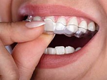 Американская компания приостановила поставки элайнеров в Россию