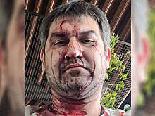 В Липецке неизвестные жестоко избили завкафедрой вуза, он впал в кому