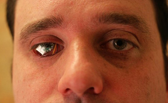 Канадец заменил свой глаз роботизированной камерой