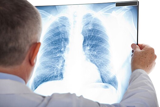 Врачи ГКБ №15 призывают серьезно относиться к пневмонии