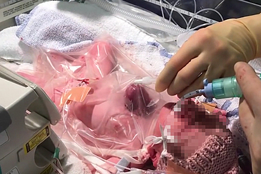 Британские хирурги впервые спасли новорожденную девочку с сердцем вне тела