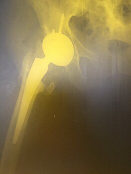 Шаг за шагом: столичные травматологи удлинили пациентке ногу