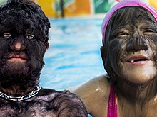 Самые редкие, странные и шокирующие заболевания, вызывающие ужас, жалость и трепет