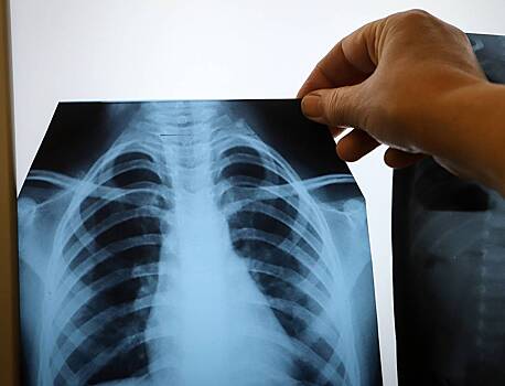 Россиянам назвали условие заражения туберкулезом