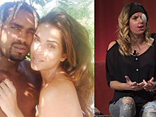 Королева красоты, которую бывший жених облил кислотой, показала изуродованное лицо