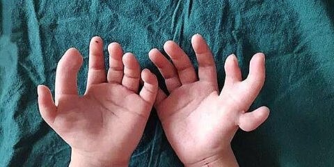 В Китае хирурги исправили руки девочки, родившейся с 14 пальцами