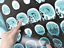 Невролог перечислила симптомы микроинсульта