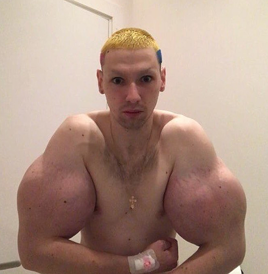 Терешин после удаления бровей