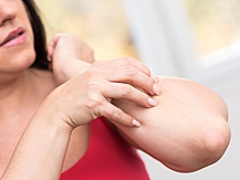 Врач Элла Чурюкина рассказала, что может вызвать отек Квинке летом