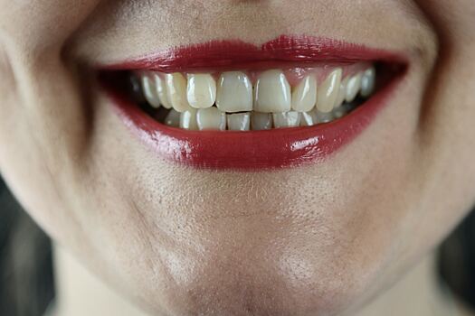Названы болезни, на которые указывает состояние зубов