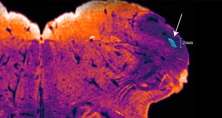 Обнаружен ранее неизвестный участок мозга