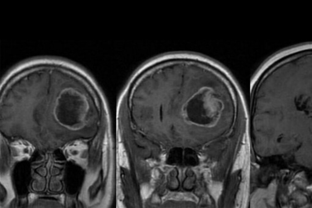 Рак мозга от эко. Вырезанные опухоли мозга. Человек сможет выжить из за опухоли мозга.