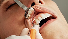 Дырки в зубах: почему появляются и как лечить
