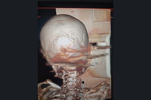 В Новосибирске вернули к жизни человека с вилами в голове