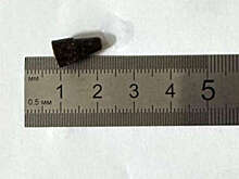 Во Владимире спасли юношу с колпачком в легких, который он вдохнул 14 лет назад