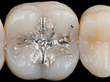 Эксперты предупредили о масштабном сбыте опасных наборов для зубов