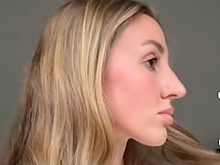 Возлюбленная Владимира Селиванова сделала пластику носа и показала результат