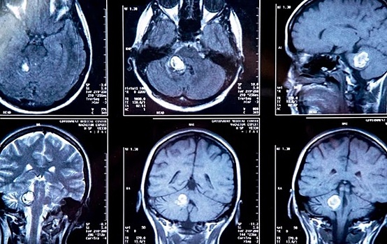 Симптомы опухоли головного мозга, скрытые в глазах