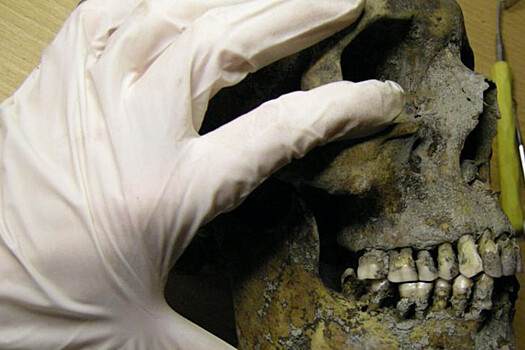 Страдавшие от боли из-за кариеса викинги спиливали себе зубы