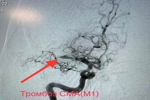 Врачи Воскресенской больницы спасли женщину с обширным инсультом