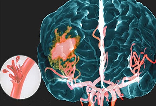 Геморрагический инсульт: причины, симптомы и лечение