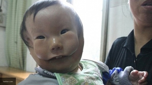 Китайских врачей ужаснул мальчик с двумя лицами
