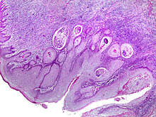 Medscape: новая модель ИИ диагностирует рак кожи с высокой точностью