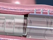 Никаких уколов: В Индии ученые разработали капсулу для инъекций