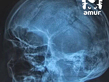 Приморчанин с раскрошенным топором черепом попал в больницу