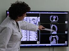 Российские ученые изобрели новый высокоточный тест на туберкулез