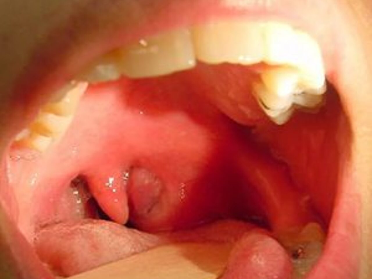 Симптомы стафилококка в полости рта — фото