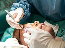 Когда нужно делать блефаропластику и как проходит восстановление